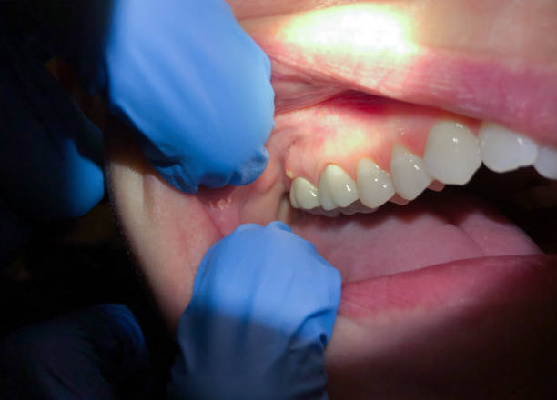 Best Emergency Denture Repair in Verona, KY